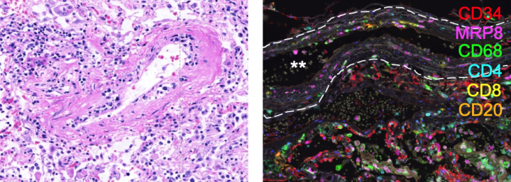 Two images of stained lung tissue, left showing abnormal blood vessels (vasculitis); right showing increased associated proteins
