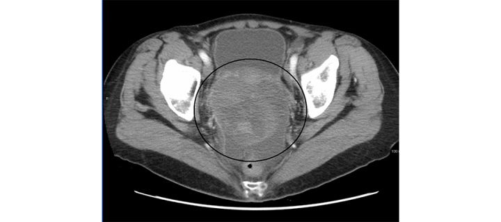 An ovarian cancer as seen on computer tomography scan (By James Heilman, MD [CC BY-SA 3.0])