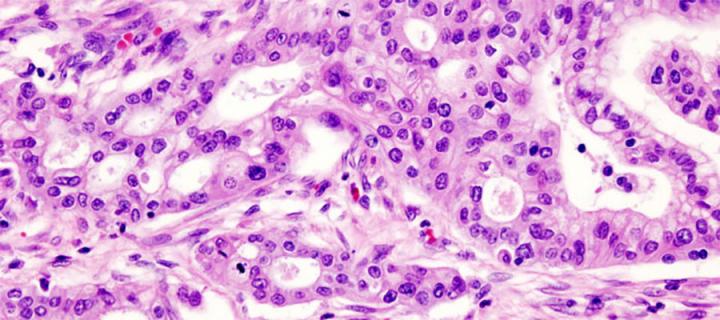 Micrograph of pancreatic ductal adenocarcinoma - the most common type of pancreatic cancer.