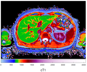Cross-sectional image through the liver (the green structure), from the 'HepaT1ca' study.