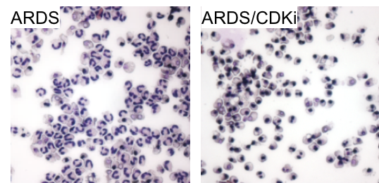 Microscopic image showing induction of apoptosis by CDKi in neutrophils from a patient with ARDS
