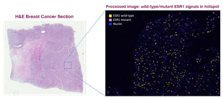 processed section of breast cancer tissue taken after development of resistance to endocrine therapy 