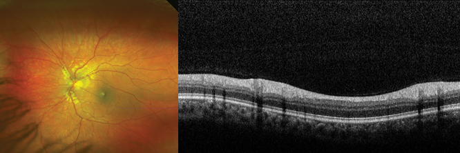 Retinal imaging up close