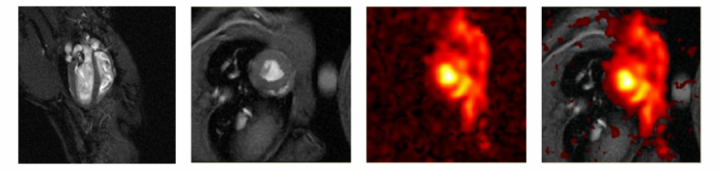 combination of four cardiac sodium 23 MRI images
