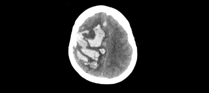 Brain scan indicating a stroke