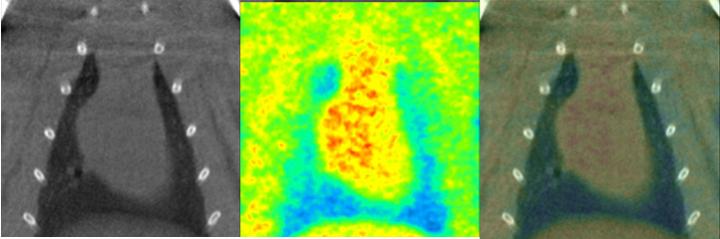 Combination of three PET images of fibrosis biomarkers