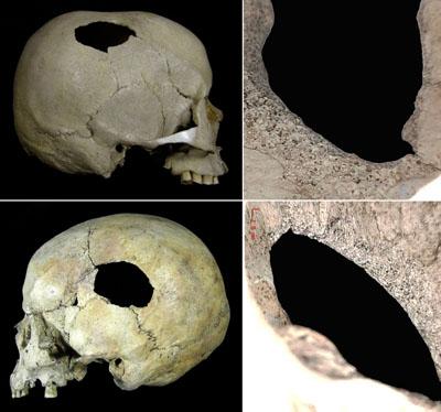 HCA Cambridge World History of Violence Perimortem blunt force injuries on skulls from the Late Jomon site of Sakaeiso