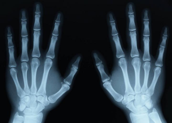 X-ray image of two hands