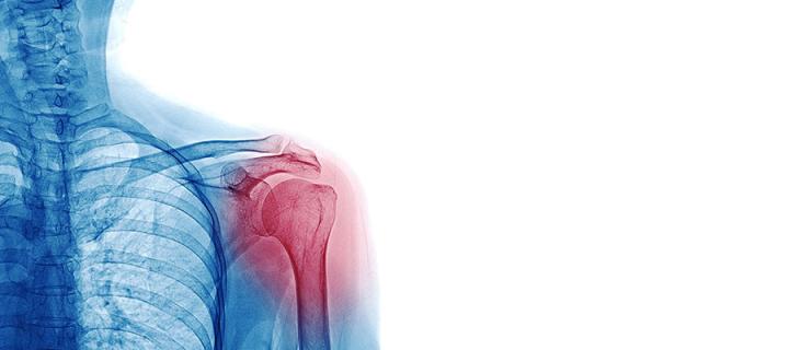 X Ray image of patient who has shoulder pain isolated on white background