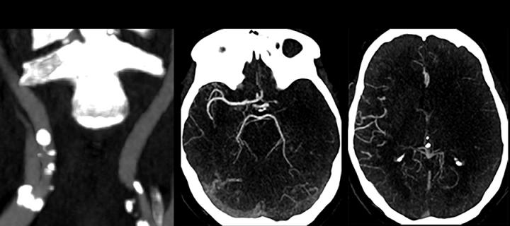 ACTATS Acute CTA for thrombectomy in stroke