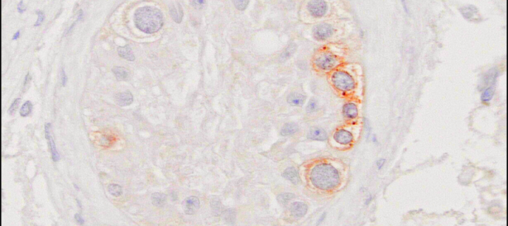 Jumping genes (brown stain) attacking germ cell DNA (blue stain) in a human testis biopsy