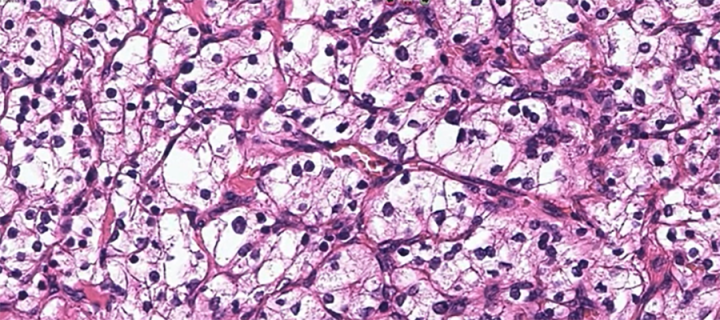 Histology section of ccRCC. Clear cell renal cell carcinoma is named after how the tumour looks under the microscope - the cells