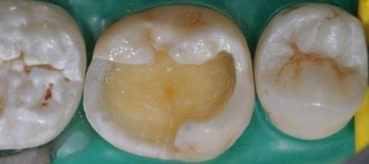 tooth pulp exposed