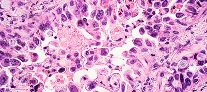 Lung cancer - adenocarcinoma