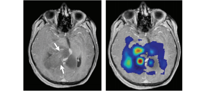 MRI images of glioblastoma (from Kao et al. BioMed Res Int: 970586).