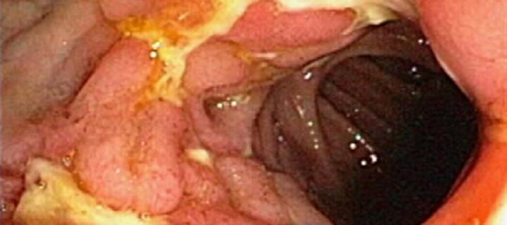 Image of Crohn's disease