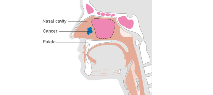 Diagram showing stage T1 nasal cancer 