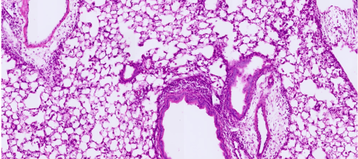 Histology image of inflamed lung tissue