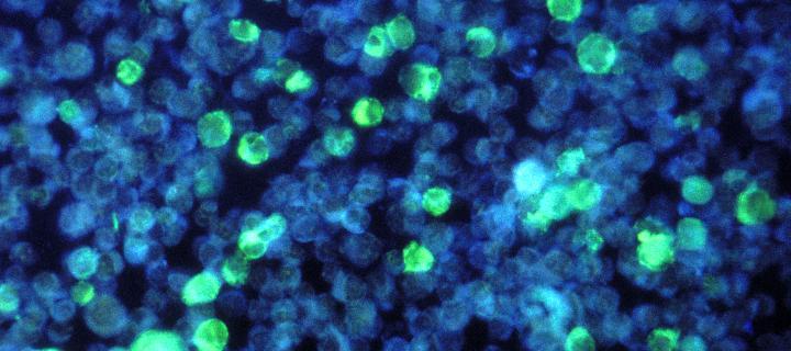 The Epstein-Barr Virus causes cell changes linked to cancer.