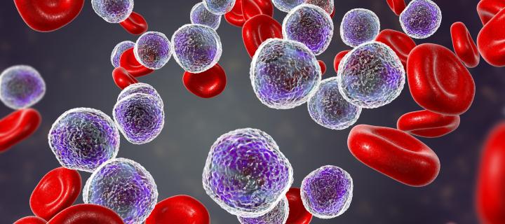 A 3D computer generated image of acute lymphoblastic leukemia with red blood cells