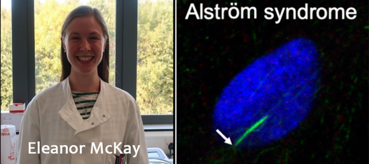 Eleanor McKay and alstrom syndrome research images
