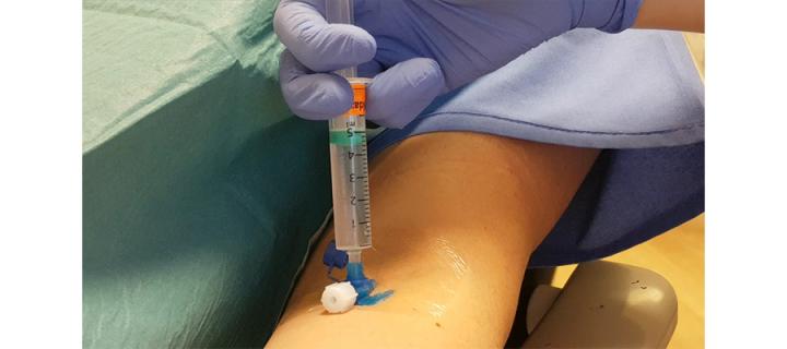 Sedation injection into lower arm