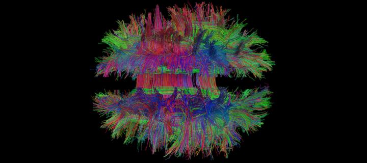 magnetic resonance image of the brain