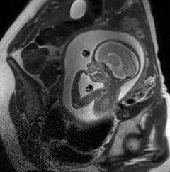 MRI of unborn baby