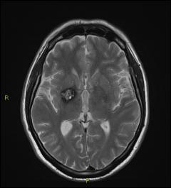 Image of Brain scan showing Cavernoma