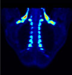 PET/CT scan showing brown adipose tissue