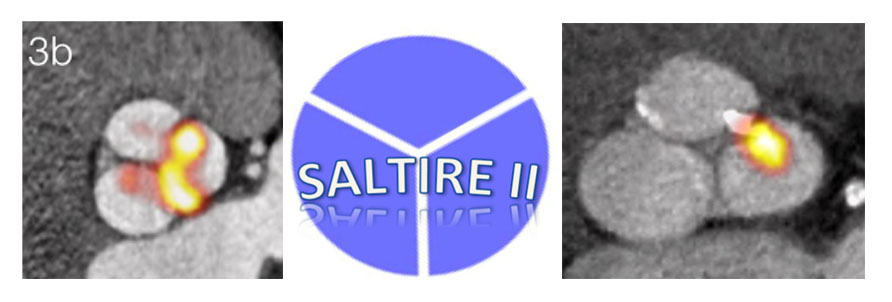 combined image of three photos (one logo and two images of the aortic valve)