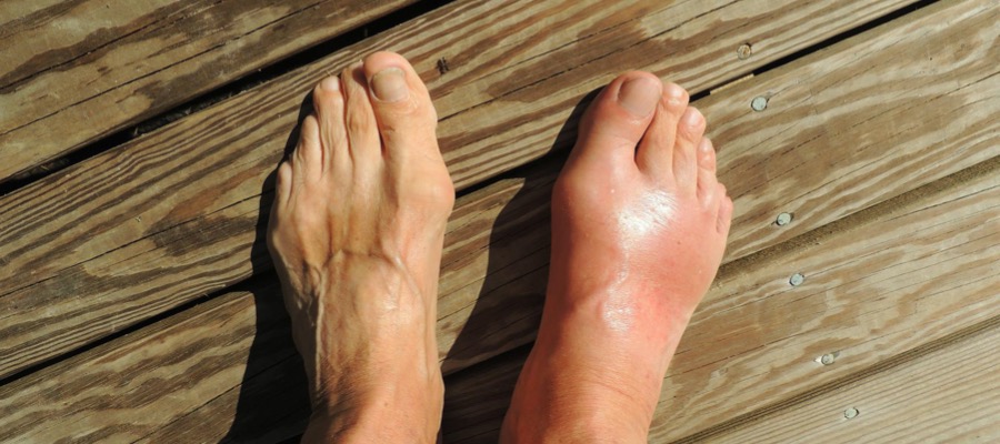 Gout feet